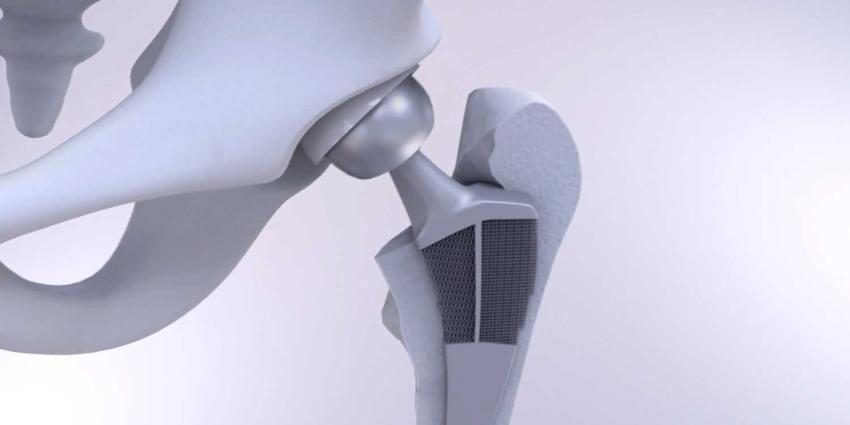 Loslatende heupimplantaten over met nieuw 3D geprint meta-implantaat Loslatende heupimplantaten over met nieuw 3D geprint meta-implantaat