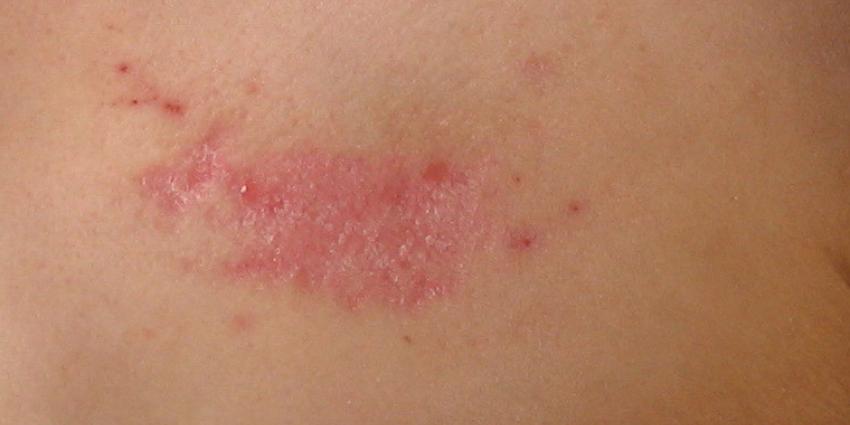 Ruim 1,2 miljoen Nederlanders hebben eczeem of psoriasis Ruim 1,2 miljoen Nederlanders hebben eczeem of psoriasis