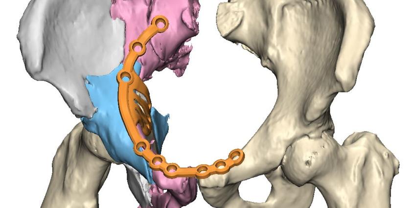UMCG voert eerste bekkenreconstructie met 3D-technologie uit UMCG voert eerste bekkenreconstructie met 3D-technologie uit