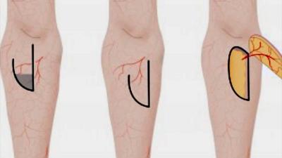 Zorgverzekeraars en overheid weigeren vergoeding behandeling brandwondenpatiënt Zorgverzekeraars en overheid weigeren vergoeding behandeling brandwondenpatiënt